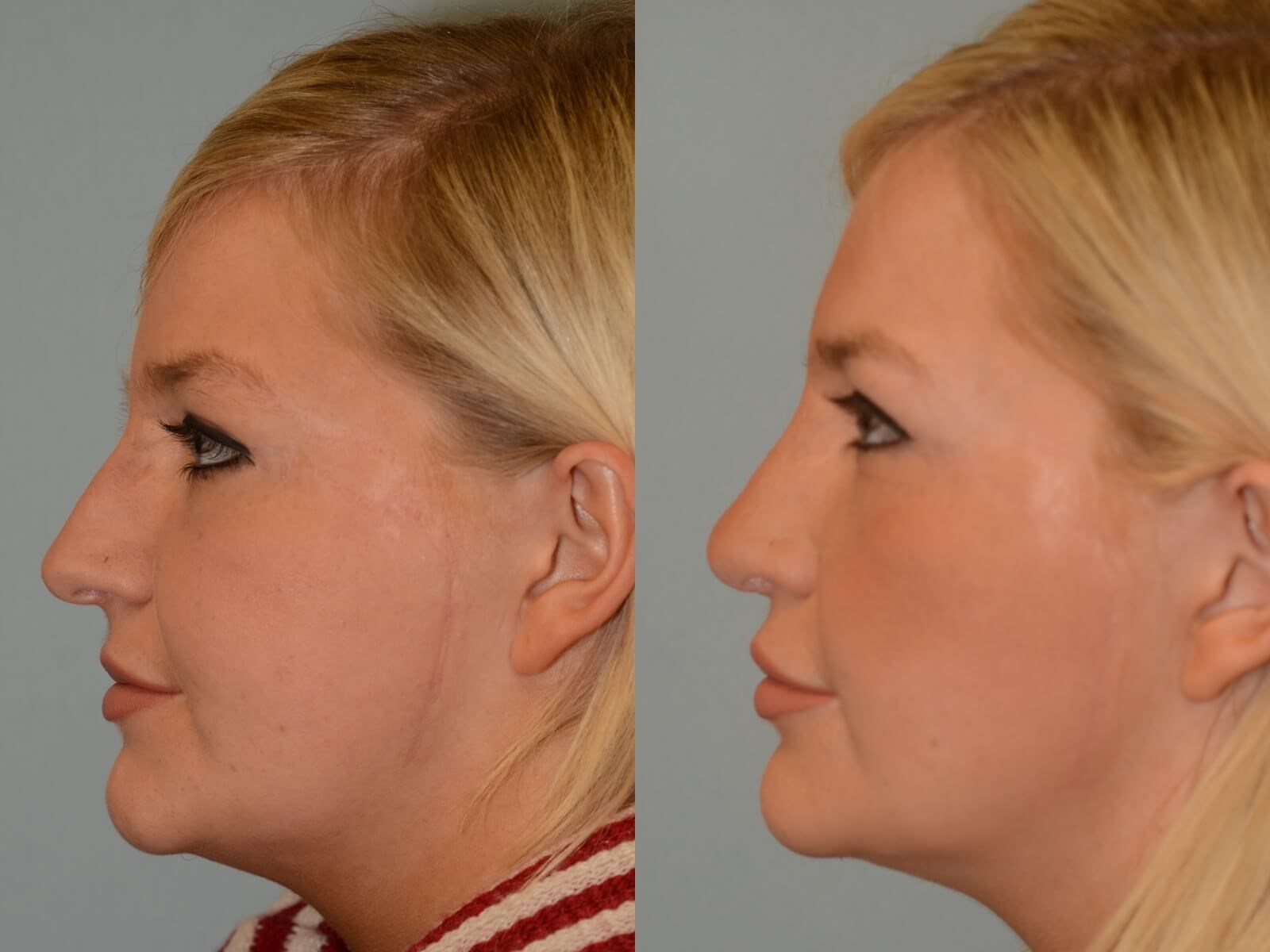 Beautiful side profile! Before and After