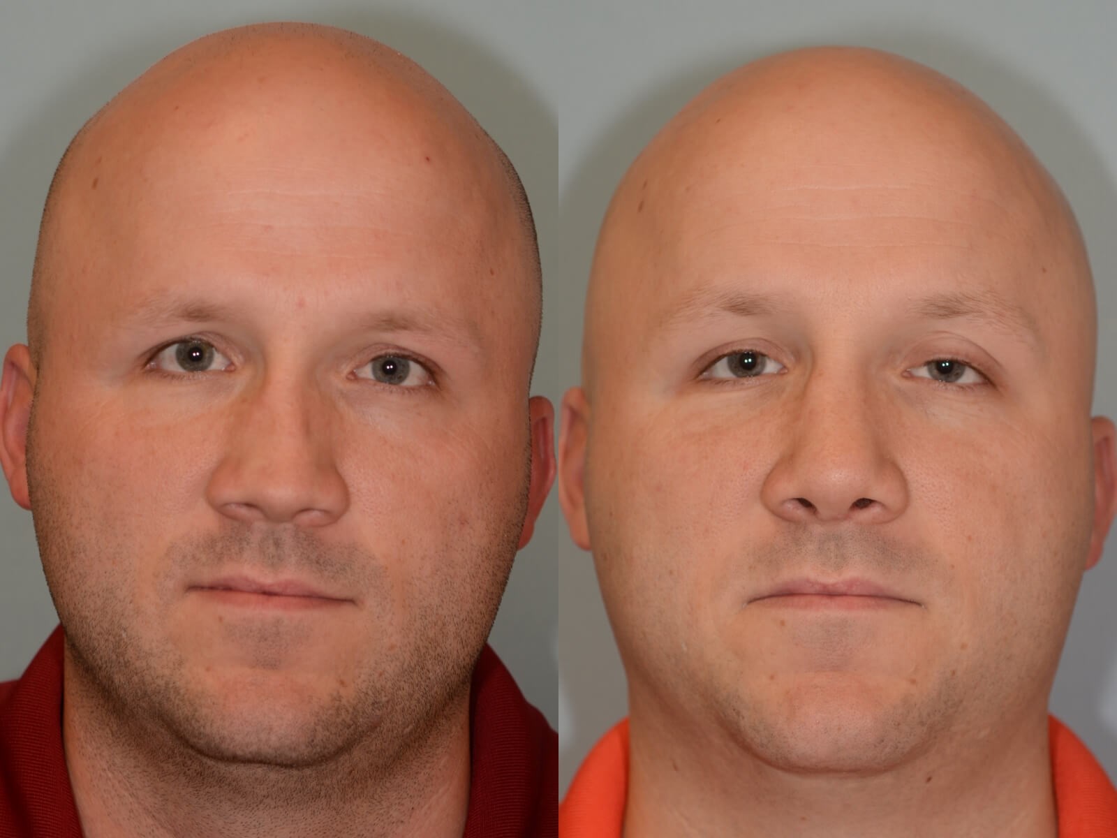 Nasal Valve Repair Before and After