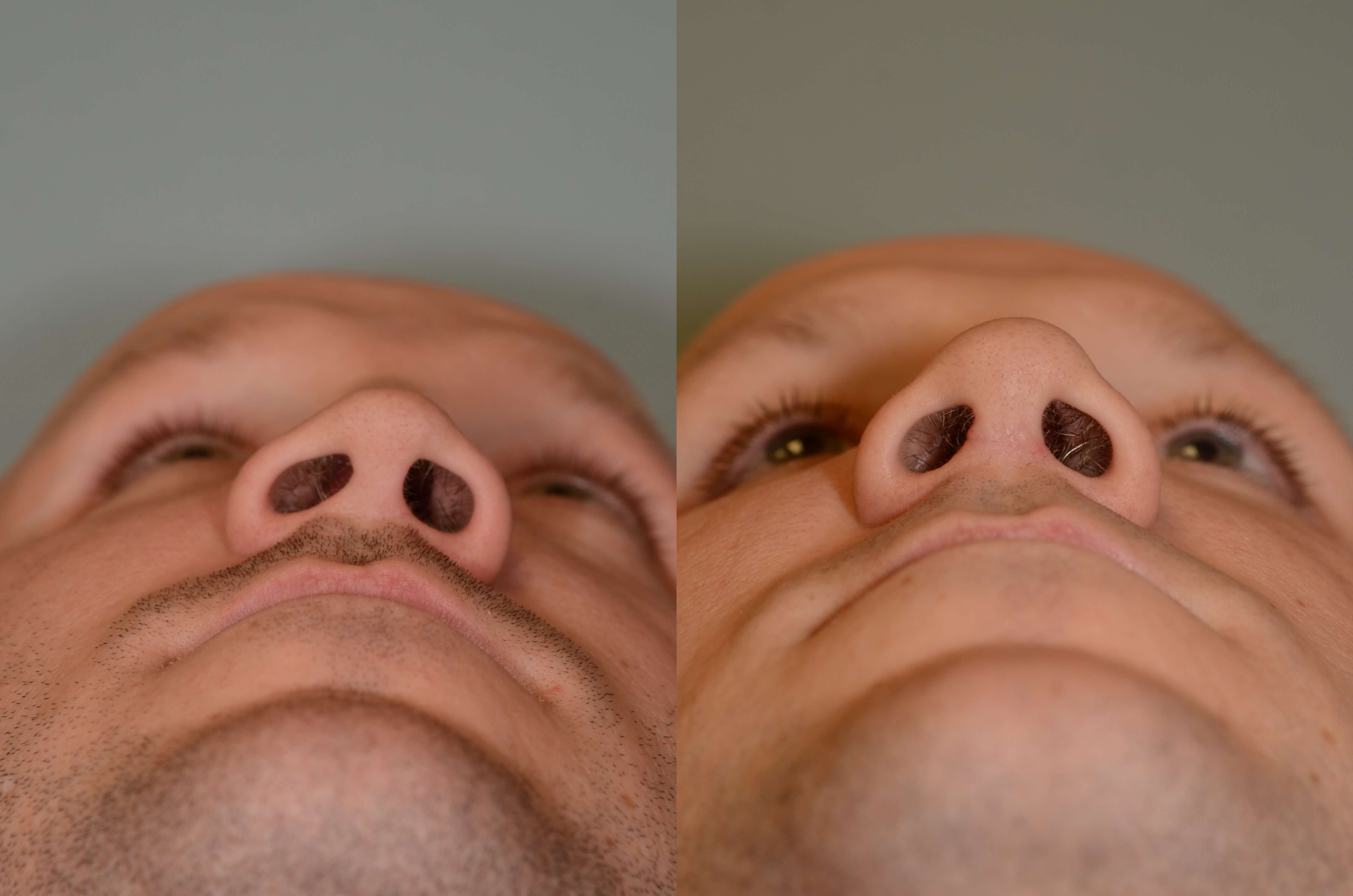 Nasal Valve Repair Before and After