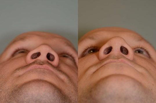 Nasal Valve Repair Before and After