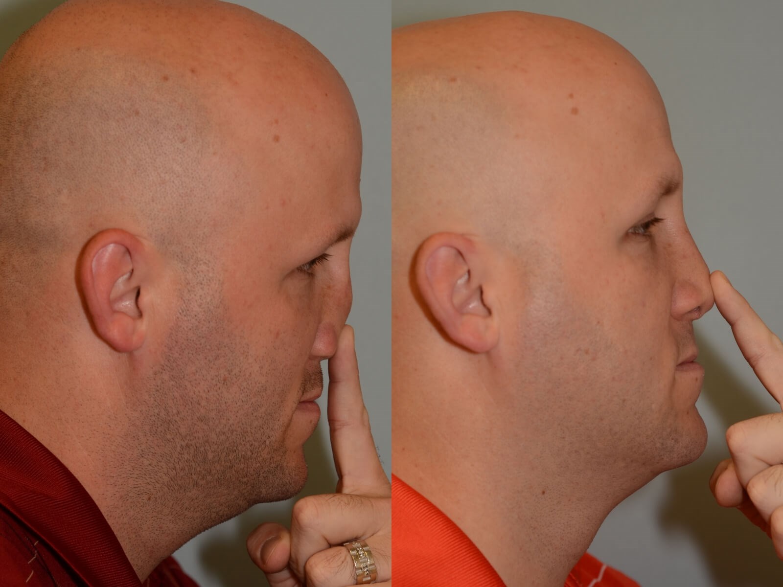 Nasal Support Restored Before and After
