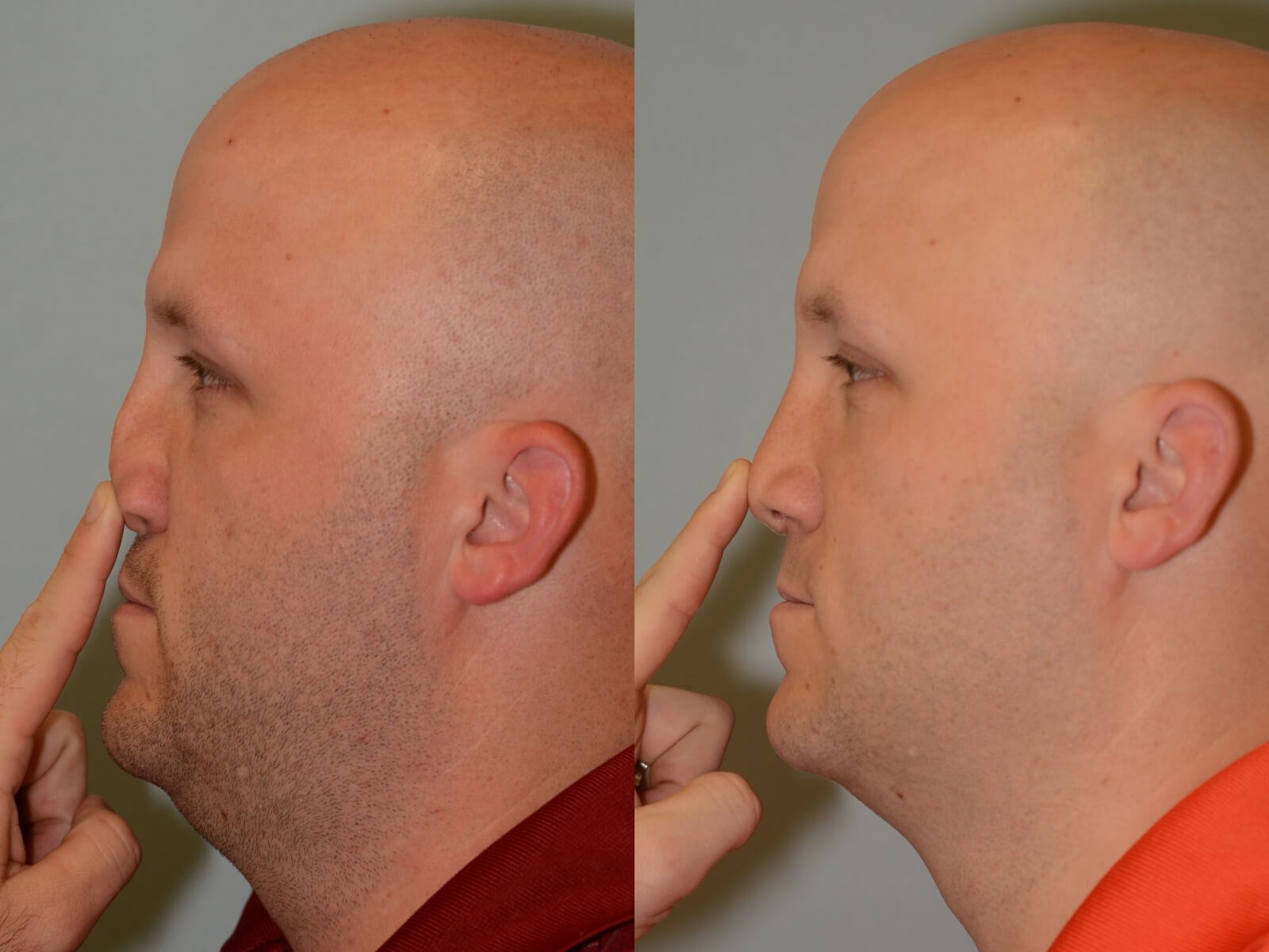 Nasal Support Restored Before and After