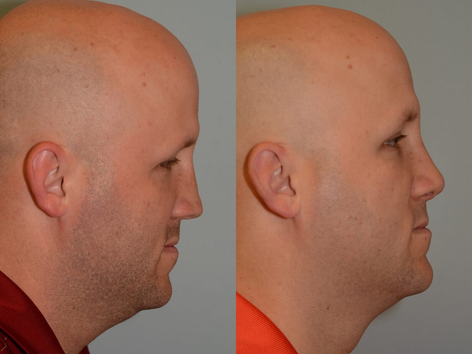 Nasal Valve Repair Before and After