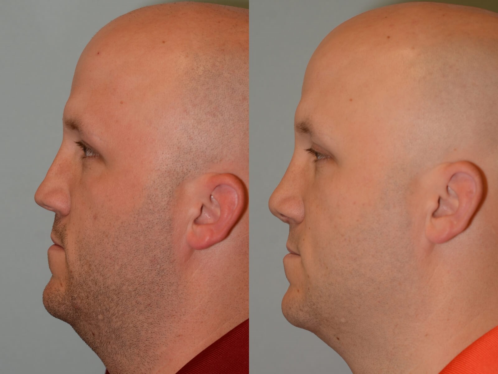 Nasal Valve Repair Before and After