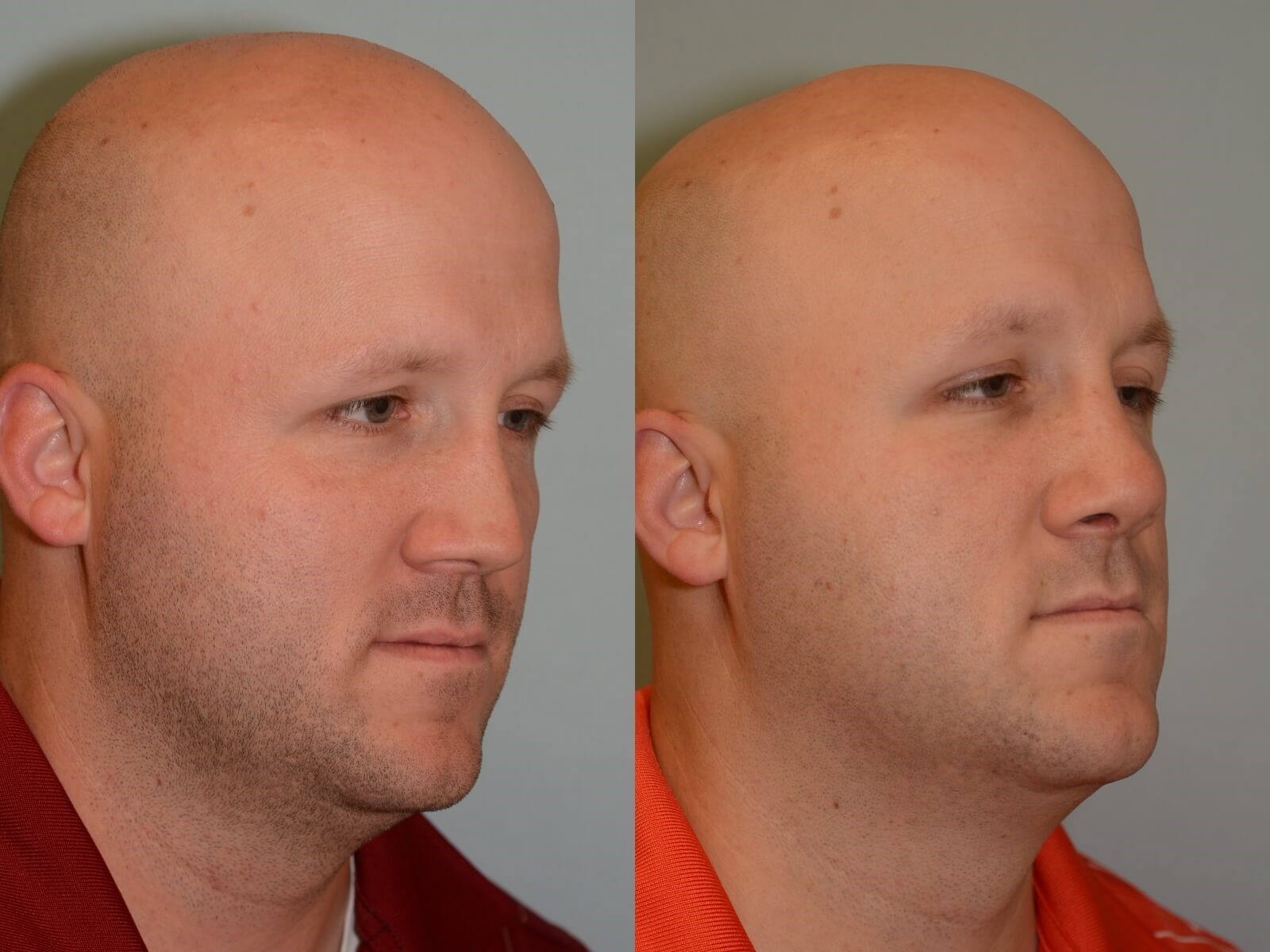 Nasal Valve Repair Before and After