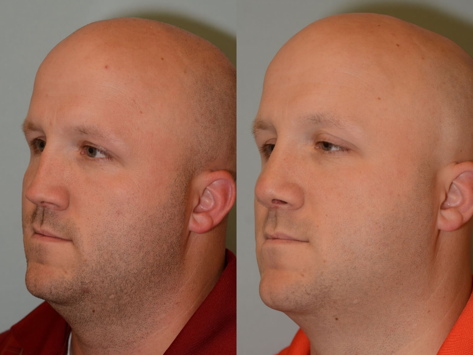 Nasal Valve Repair Before and After