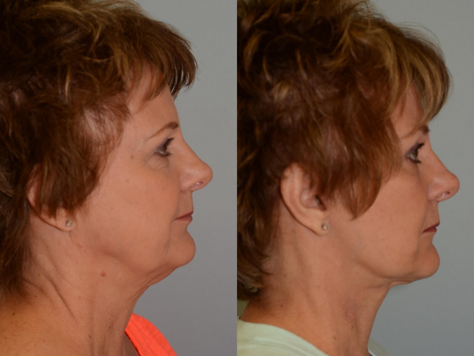 Looking 20 years younger! Before and After