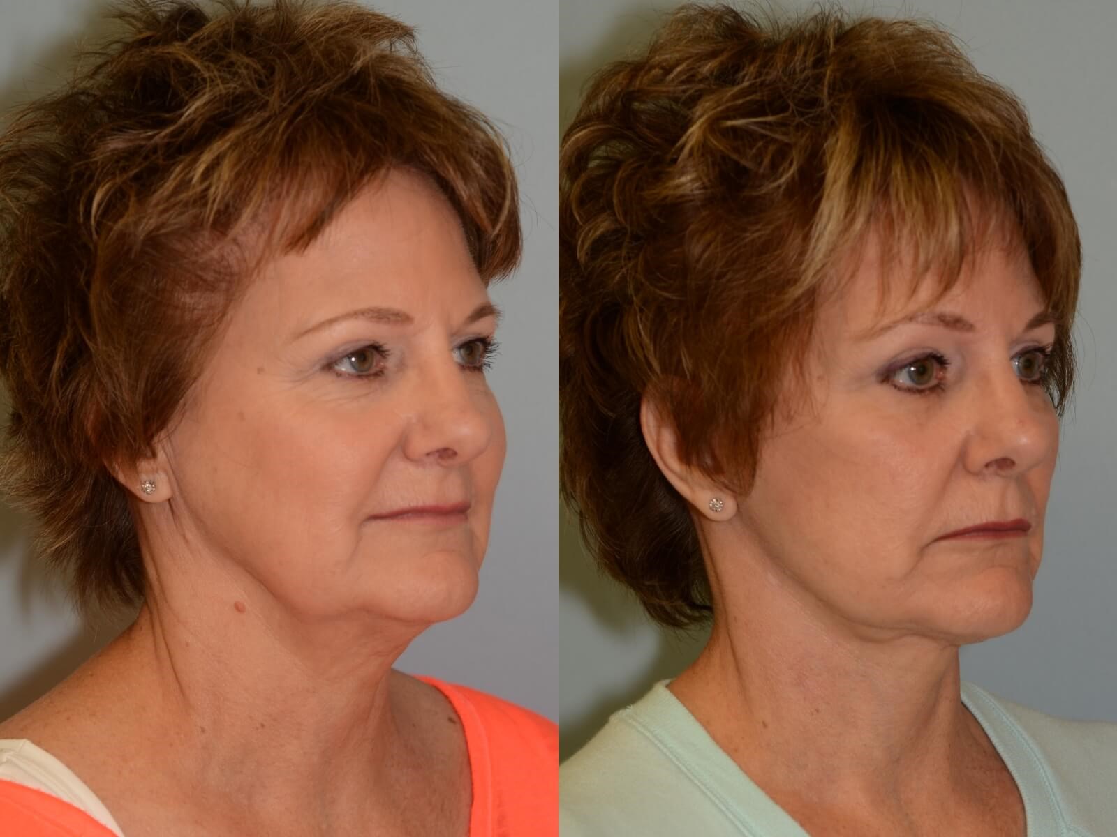 Refreshed and Radiant Before and After