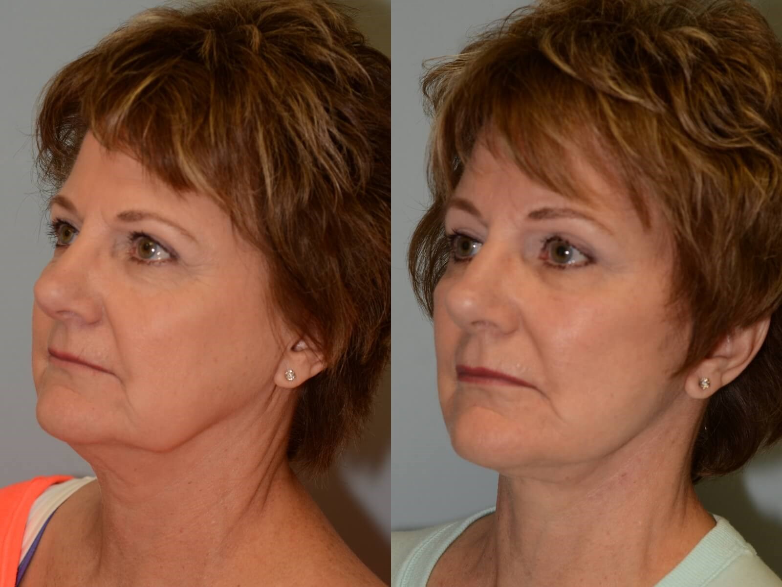 Refreshed and Radiant Before and After