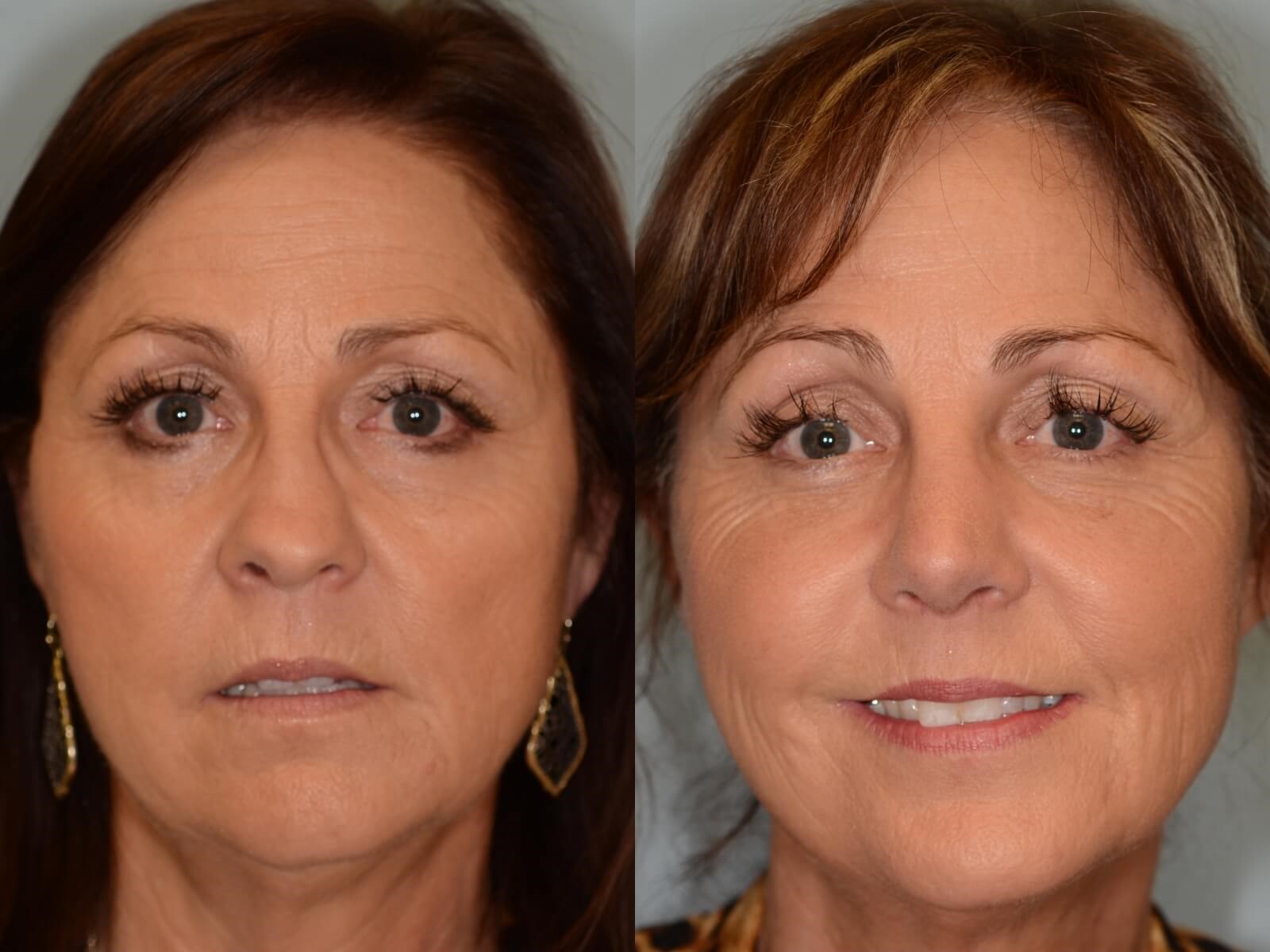 Nasal Valve Repair Rhinoplasty Before and After