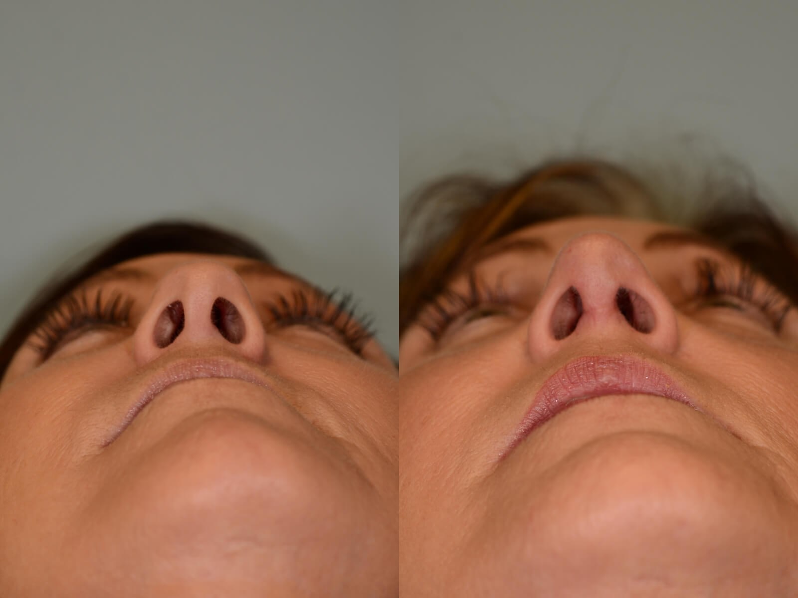 Nasal Valve Repair Rhinoplasty Before and After