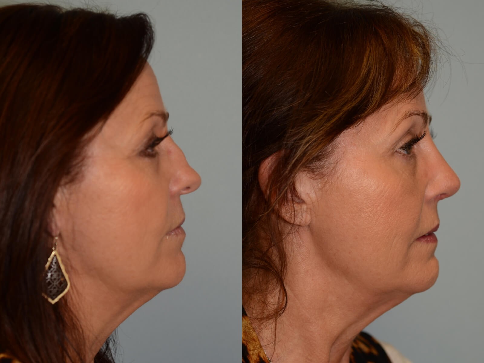Dramatic improvement in slope! Before and After