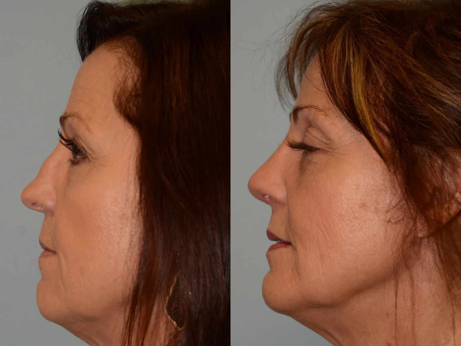 Dramatic improvement in slope! Before and After