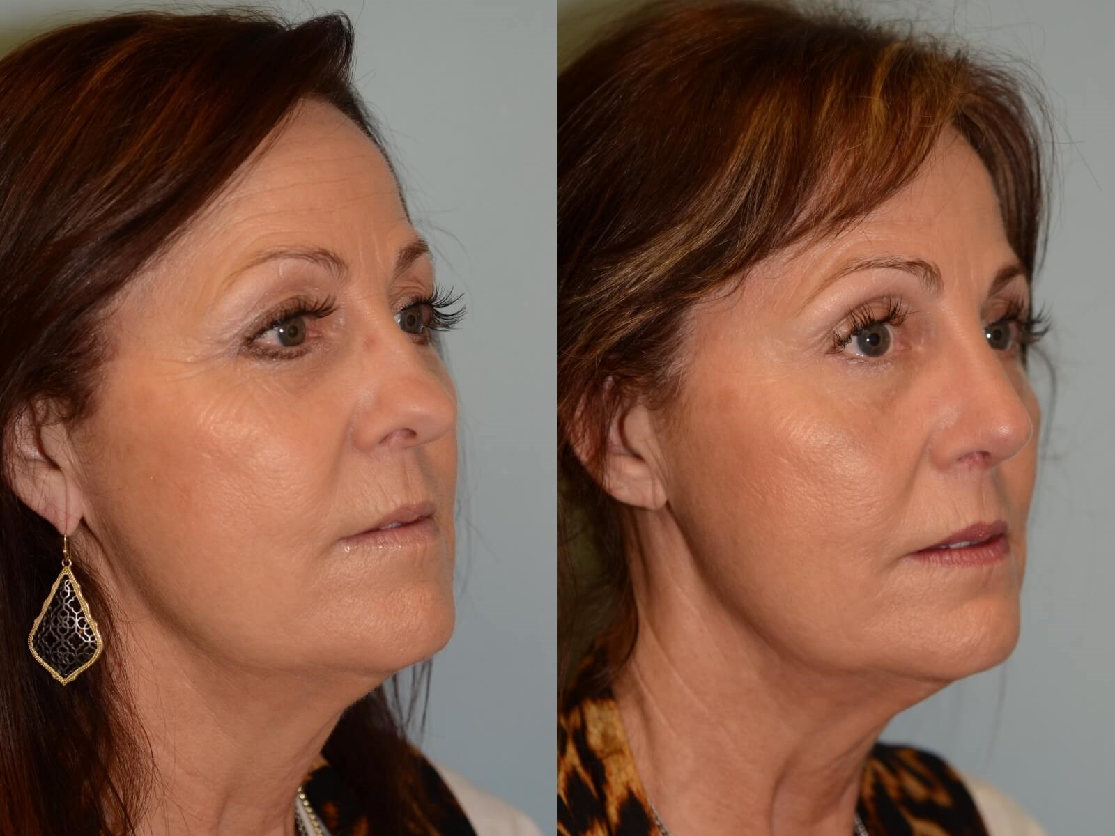 Smooth slope to nose restored Before and After