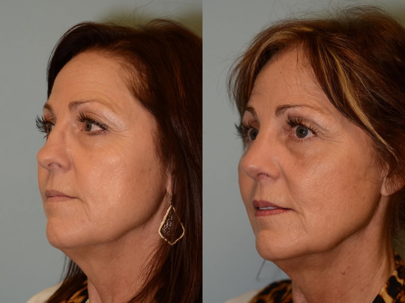 Smooth slope to nose restored Before and After