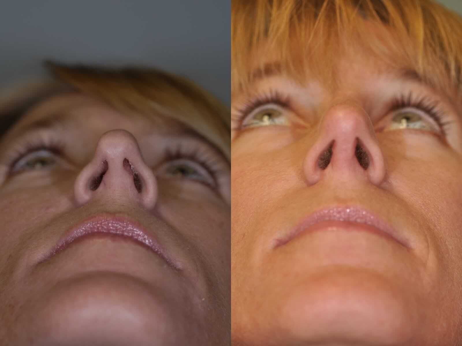 Rhinoplasty Nasal Valve Before and After