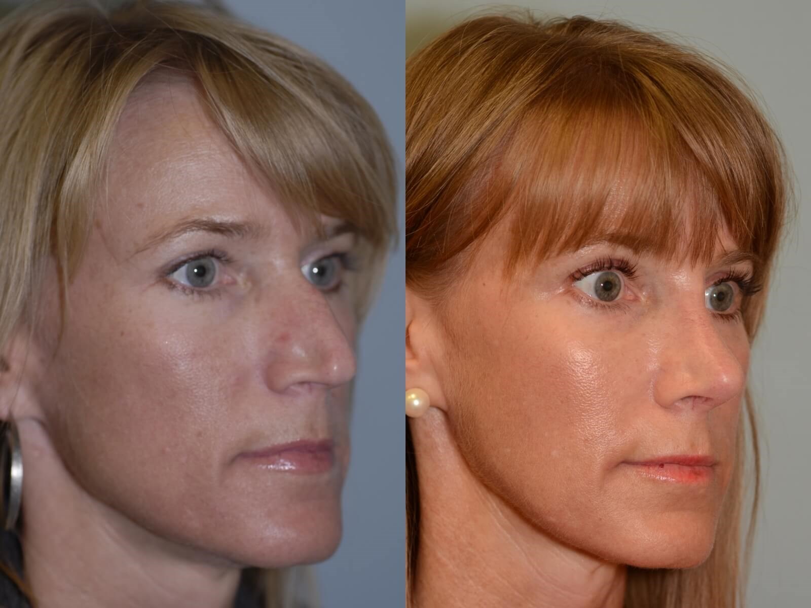 A more feminine, fitting nose Before and After