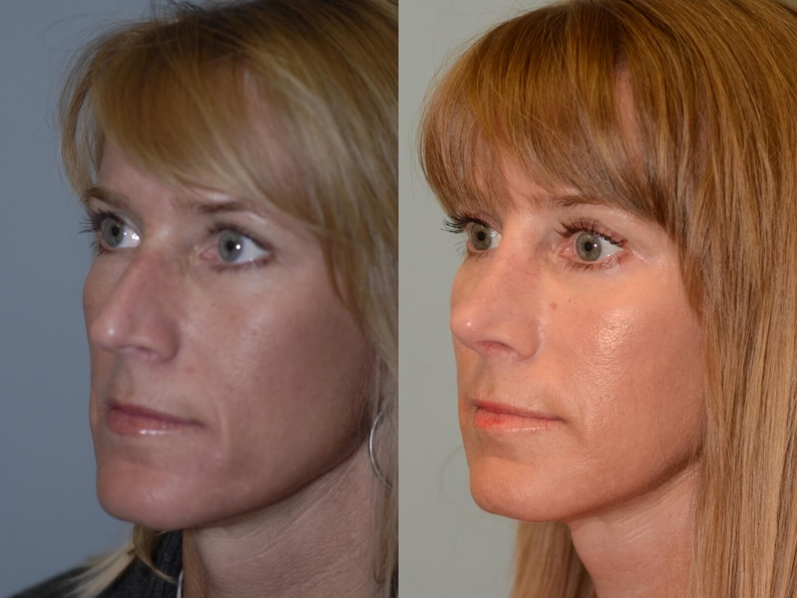 A more feminine, fitting nose Before and After