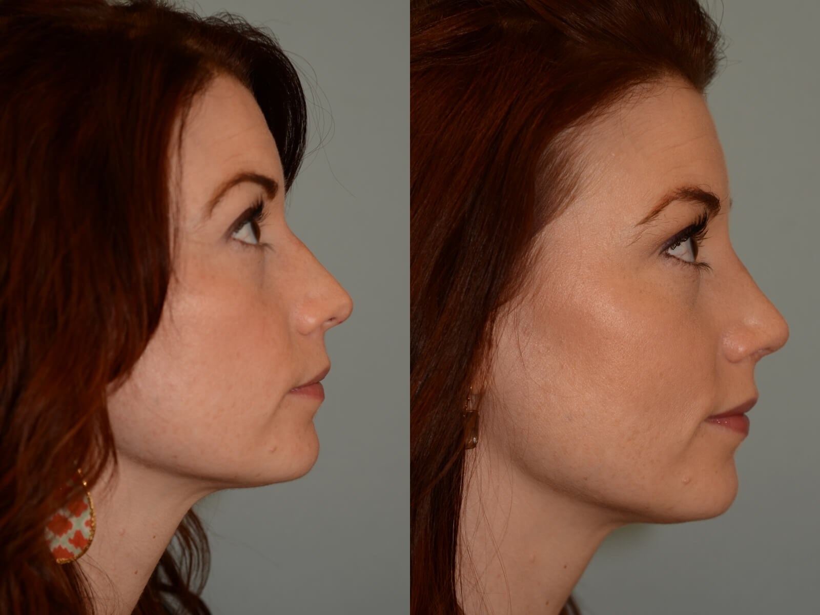 Beautiful slope to the nose! Before and After