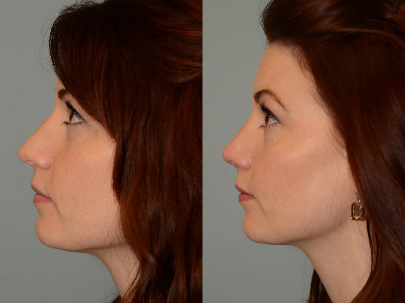 Beautiful slope to the nose! Before and After