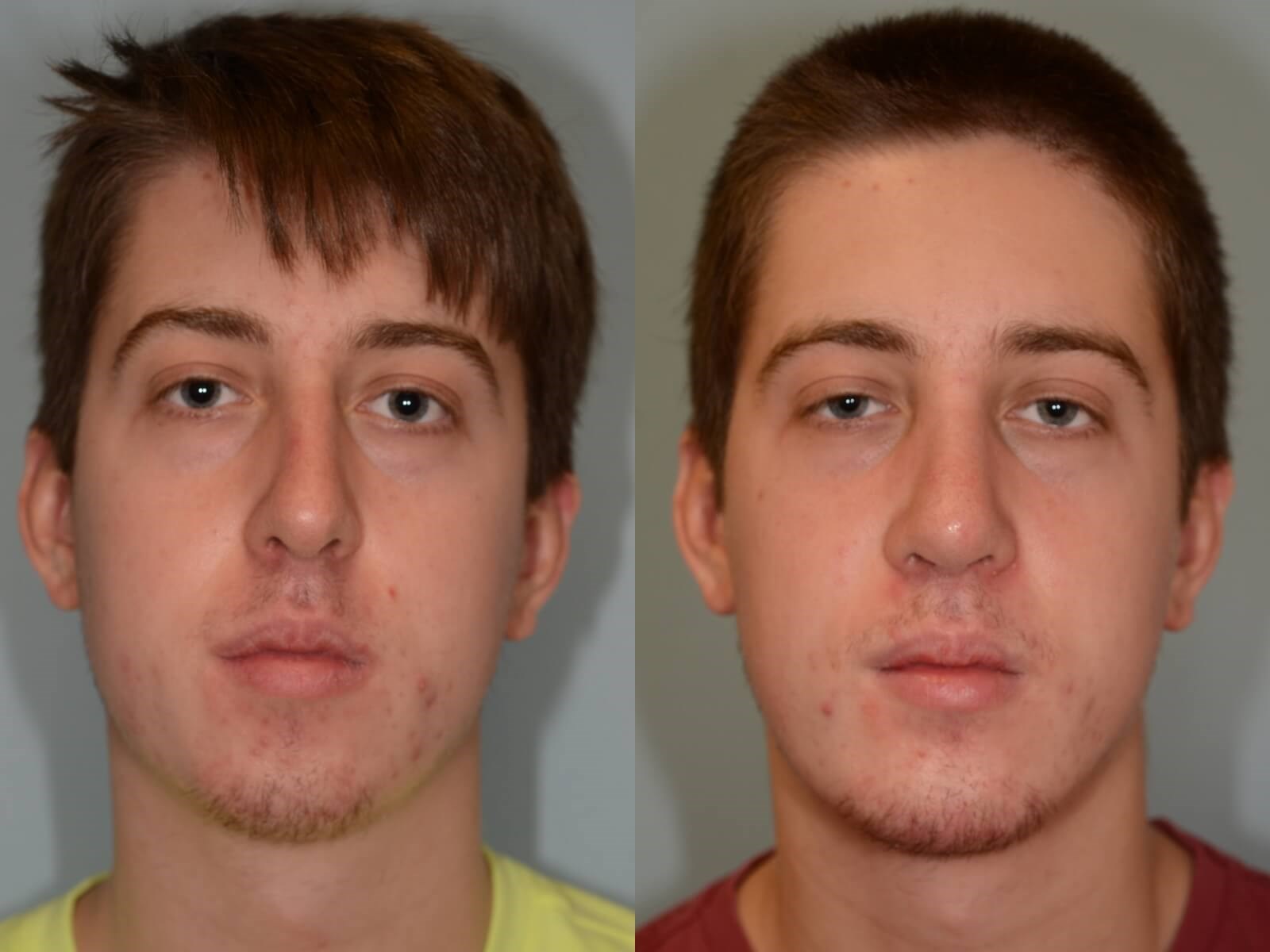 Rhinoplasty Chin Implant Before and After