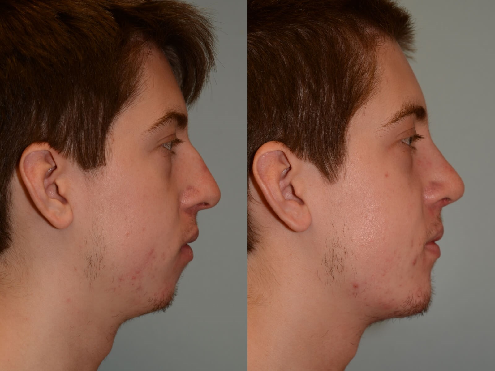 Chin Implant Rhinoplasty Before and After