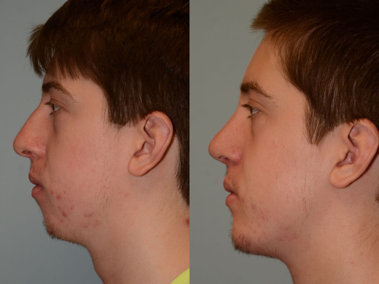 Chin Implant Rhinoplasty Before and After