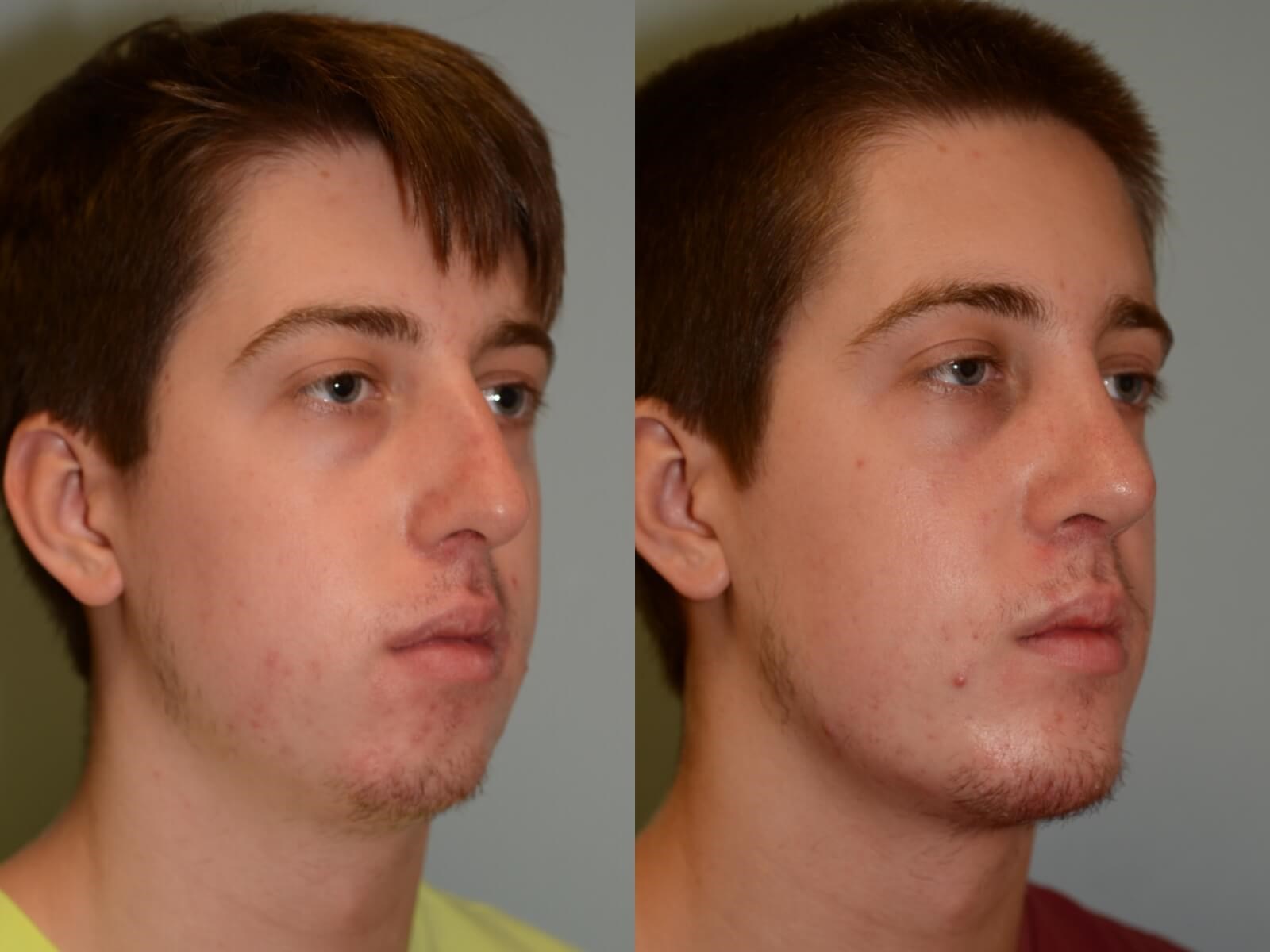 Chin Implant Rhinoplasty Before and After