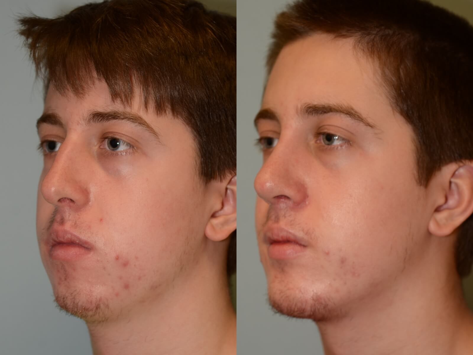 Chin Implant Rhinoplasty Before and After