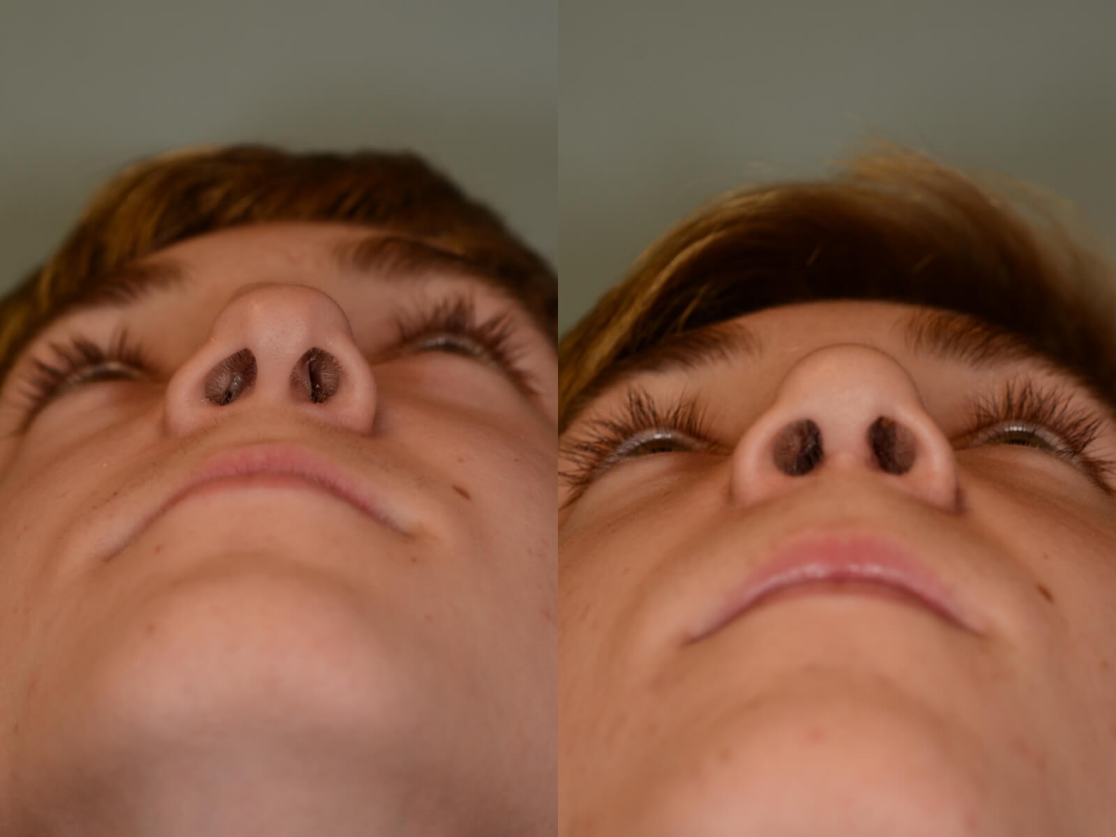 Rhinoplasty Before and After