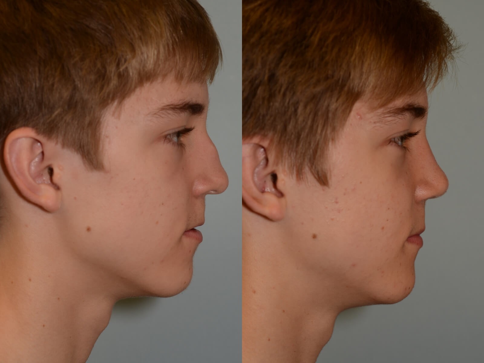 Rhinoplasty Before and After