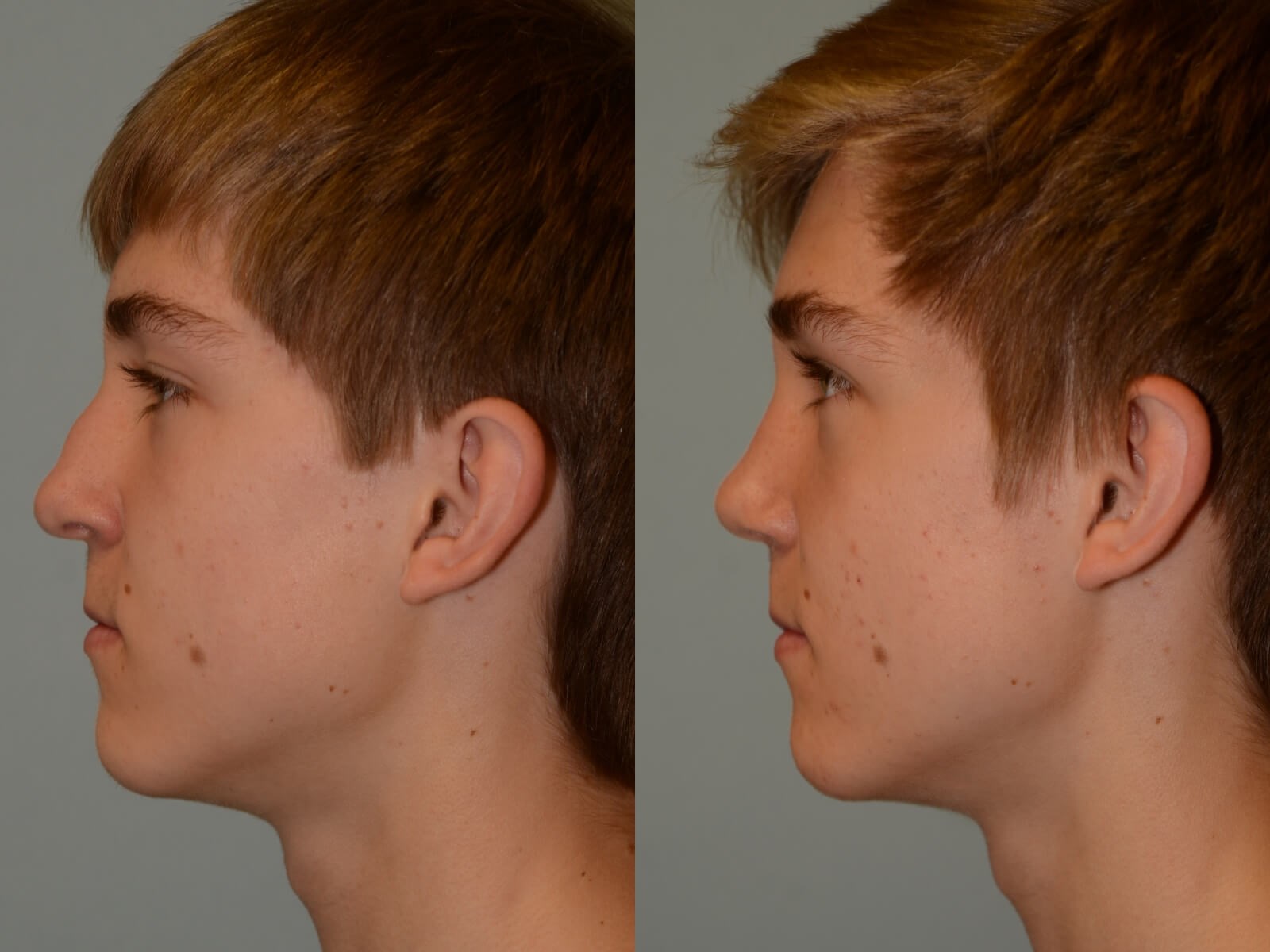 Rhinoplasty Before and After