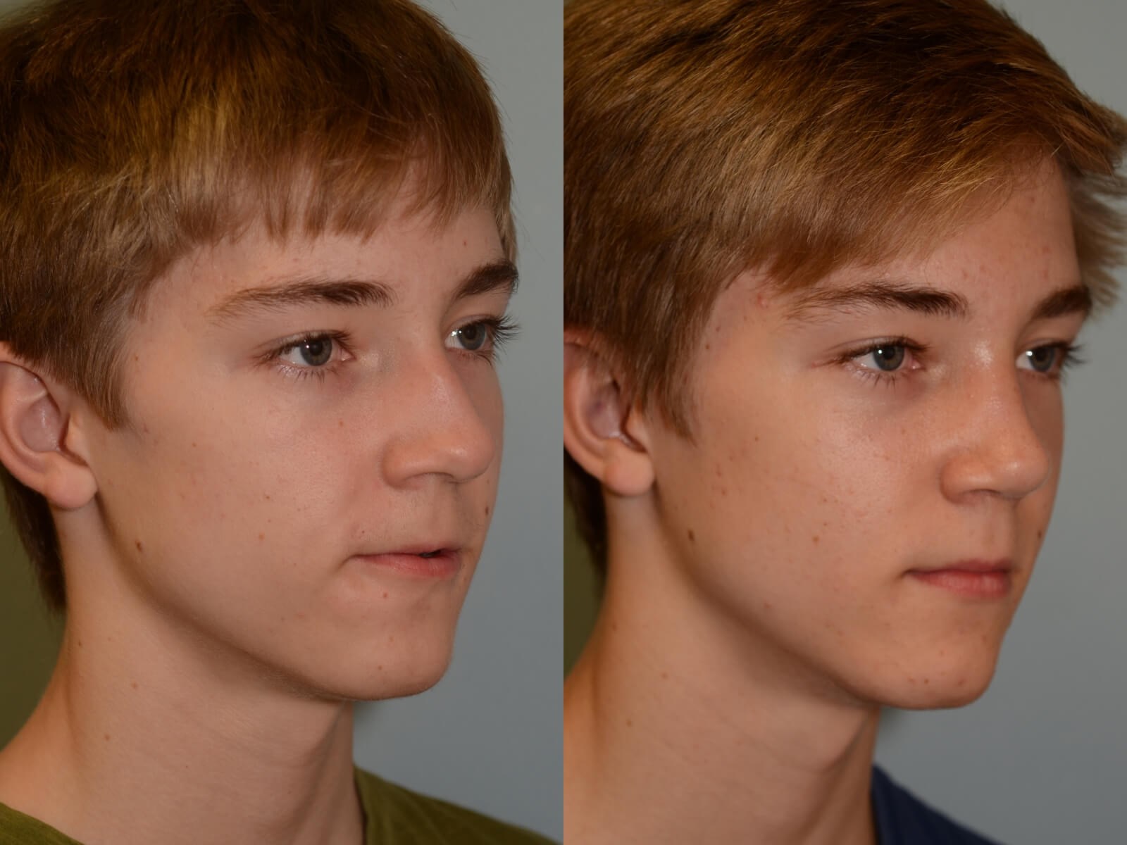 Rhinoplasty Before and After