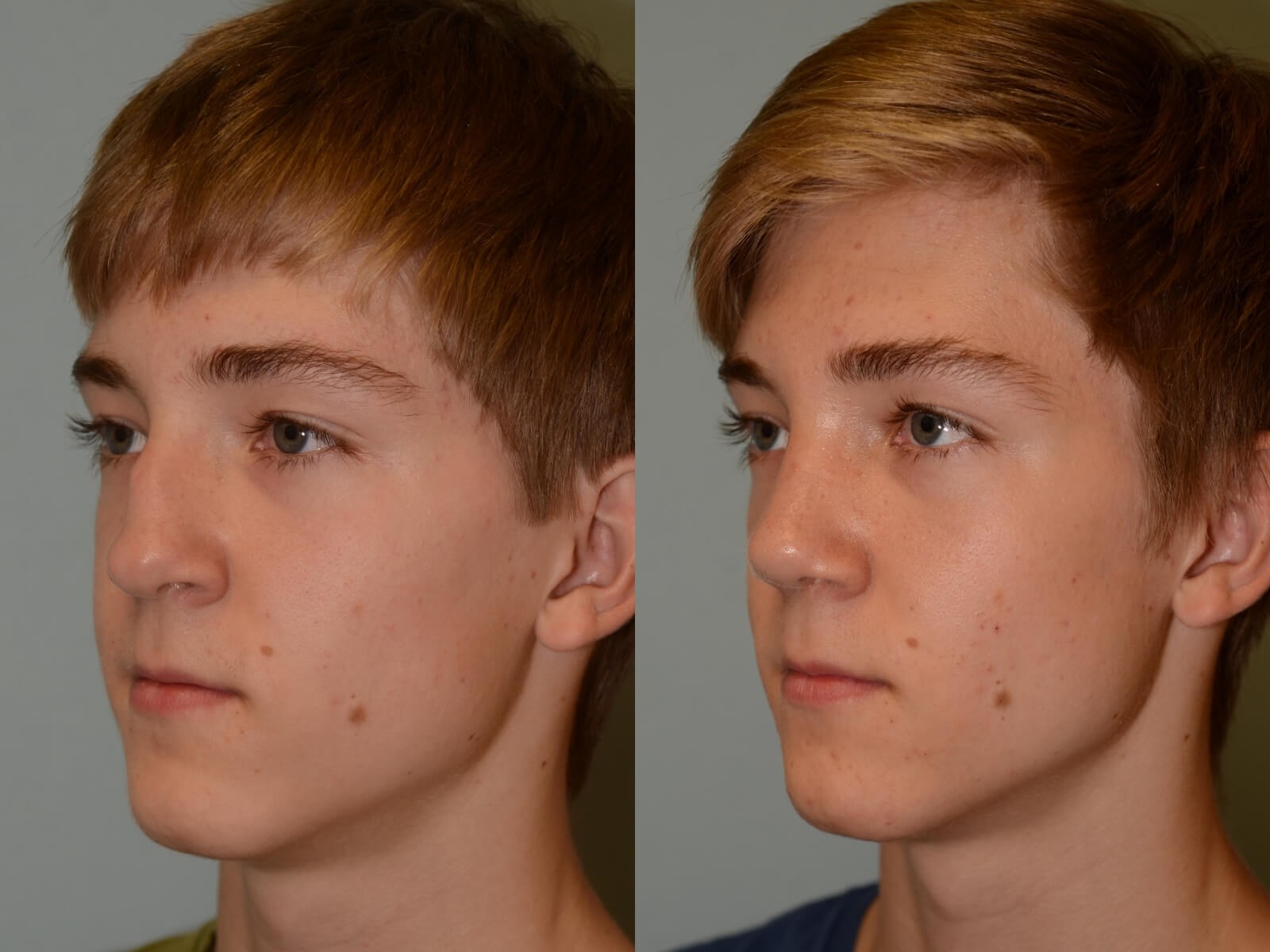 Rhinoplasty Before and After