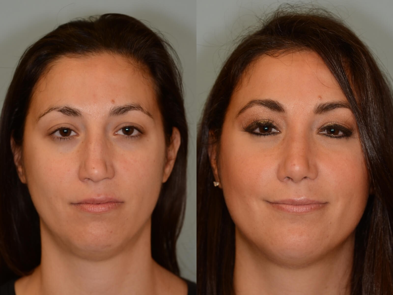 Rhinoplasty Before and After