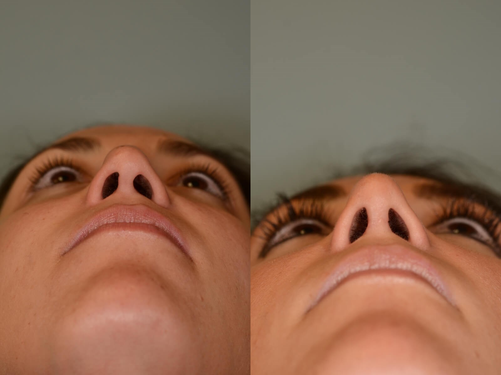 Rhinoplasty Before and After