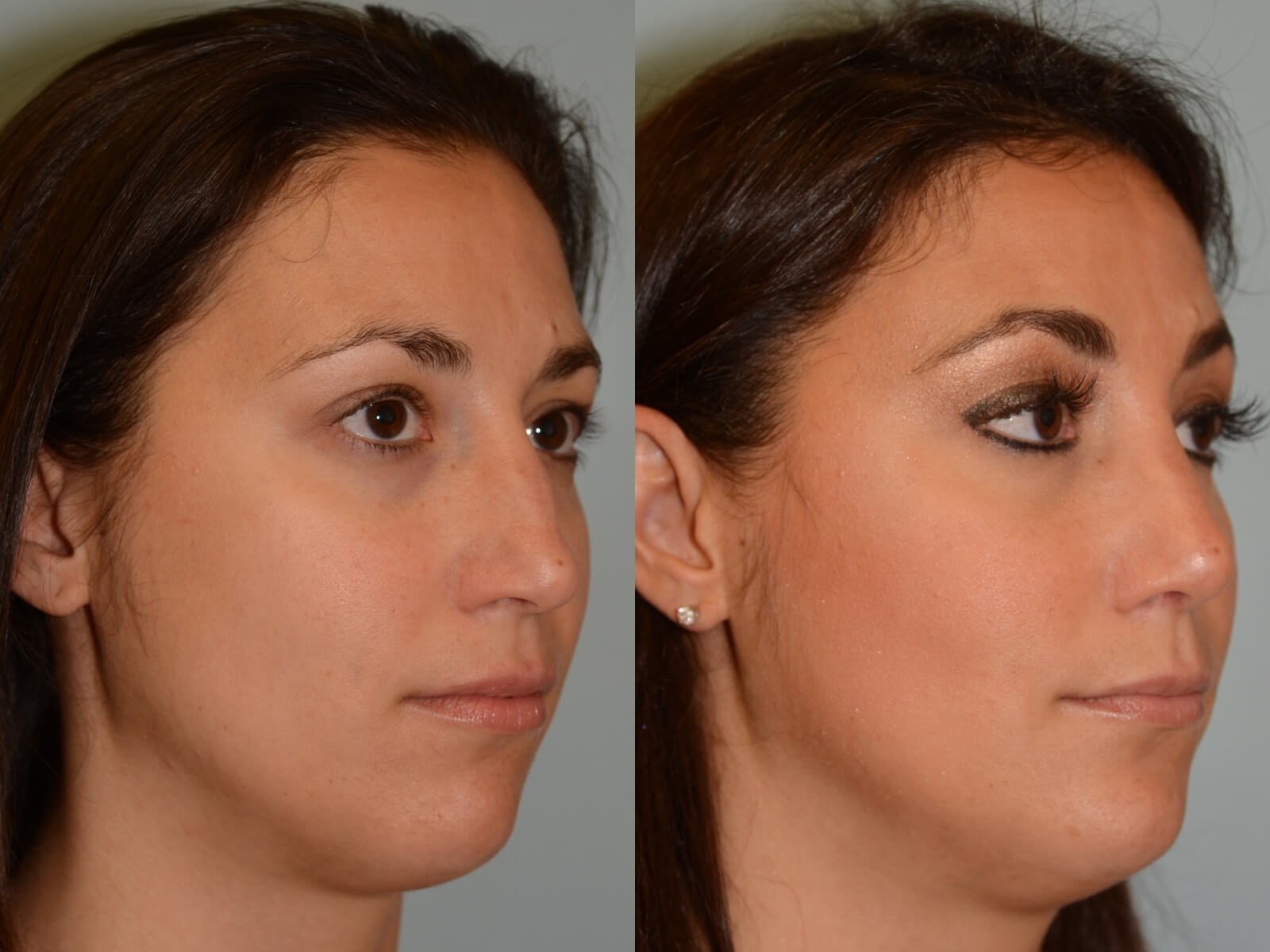 Rhinoplasty Before and After