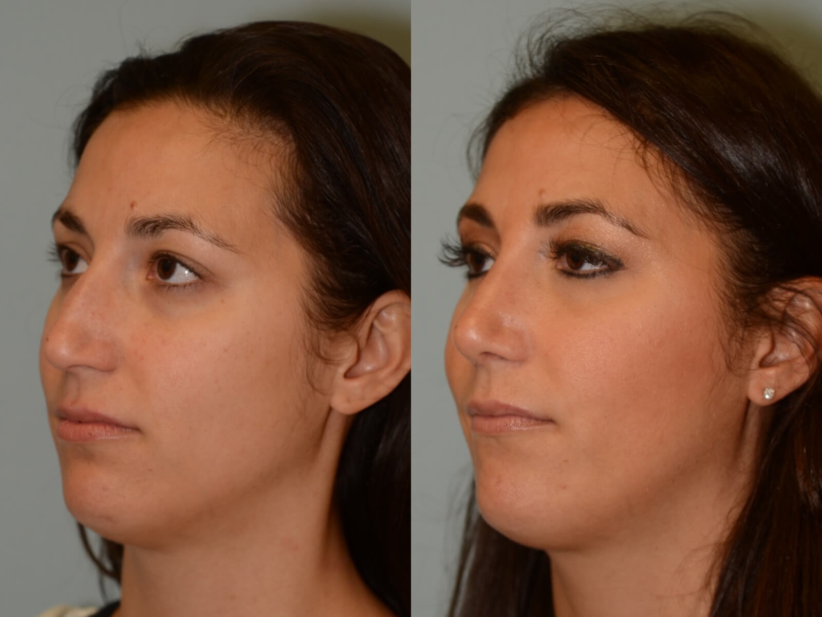 Rhinoplasty Before and After