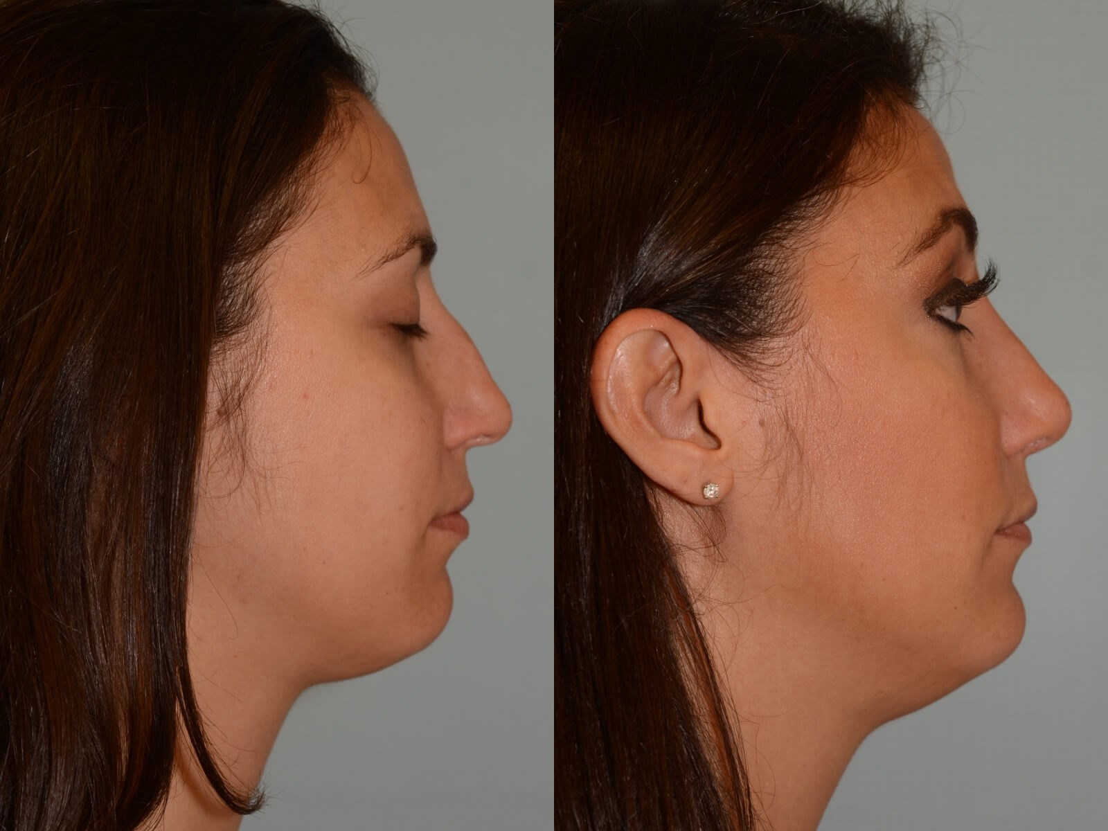 Rhinoplasty Before and After