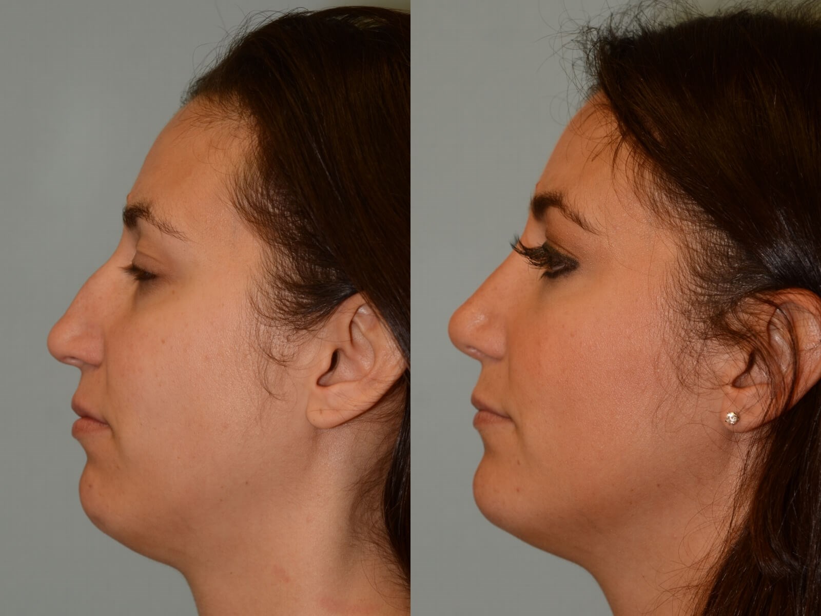 Rhinoplasty Before and After