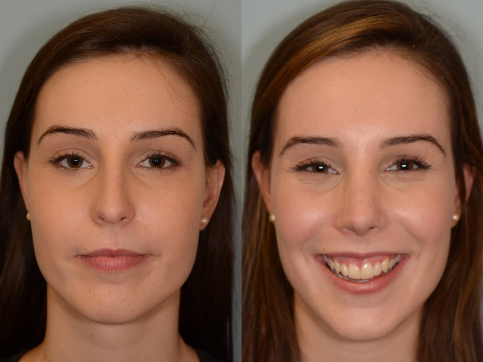Rhinoplasty Before and After
