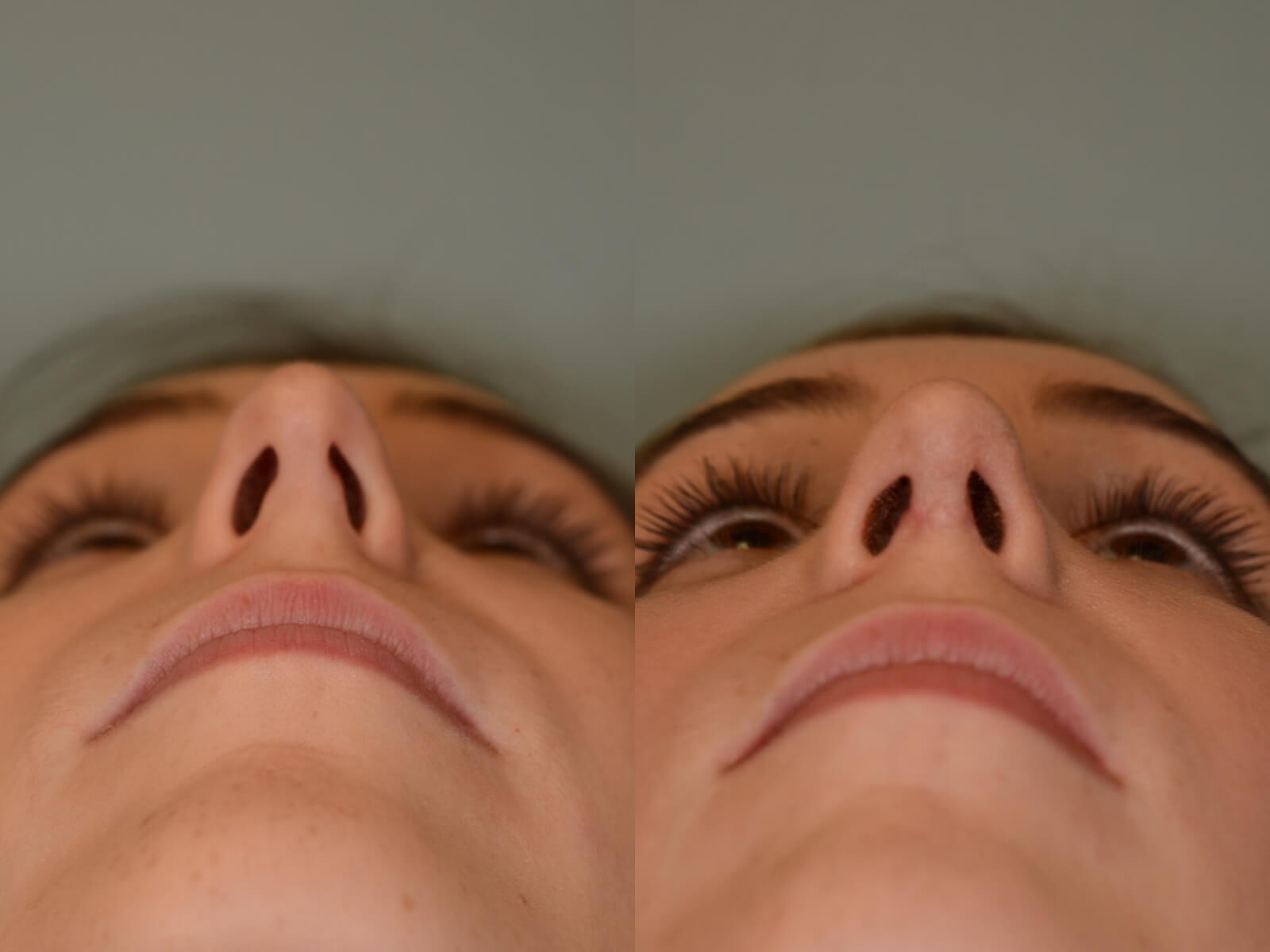 Rhinoplasty Before and After