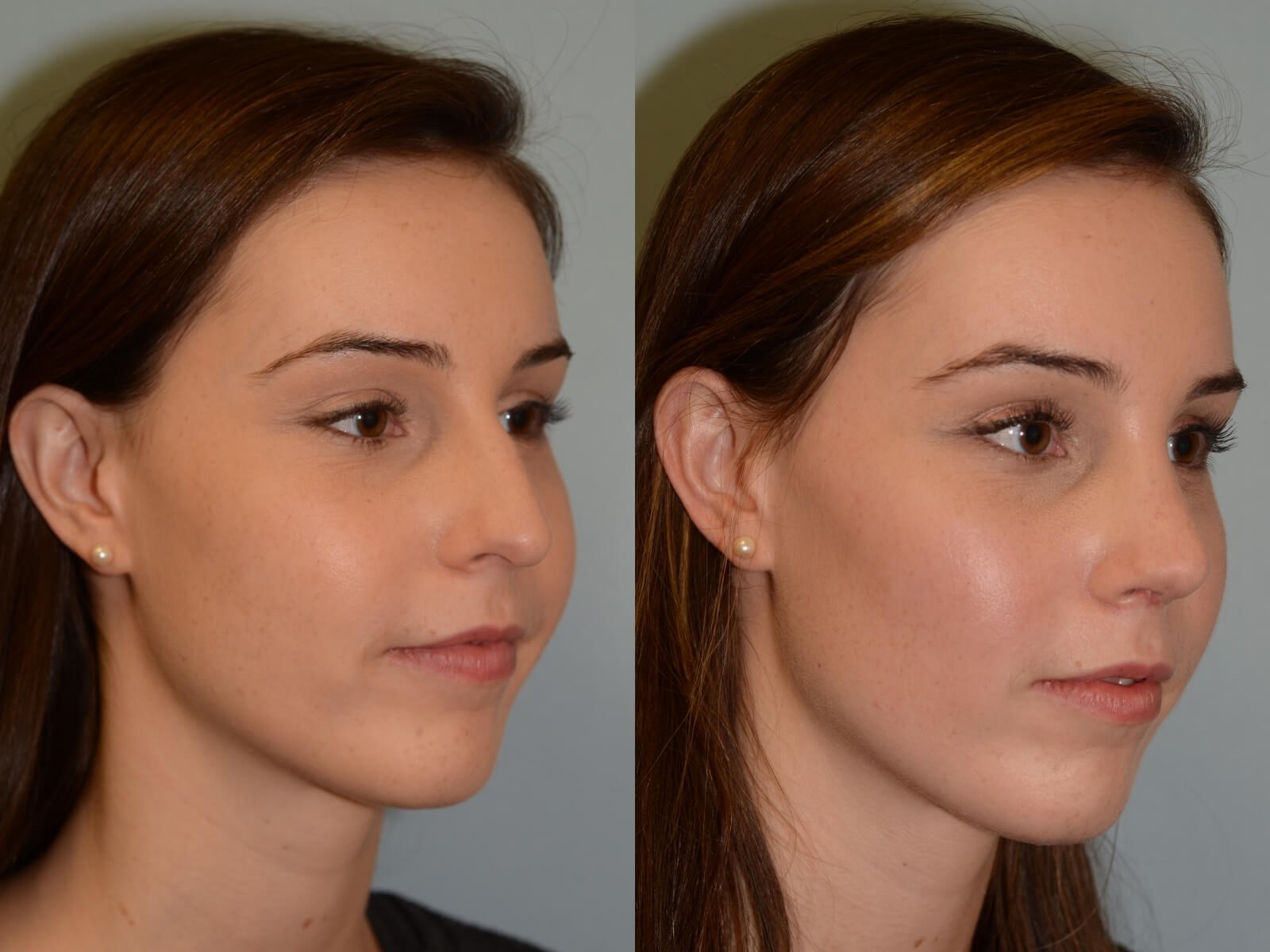 Rhinoplasty Before and After