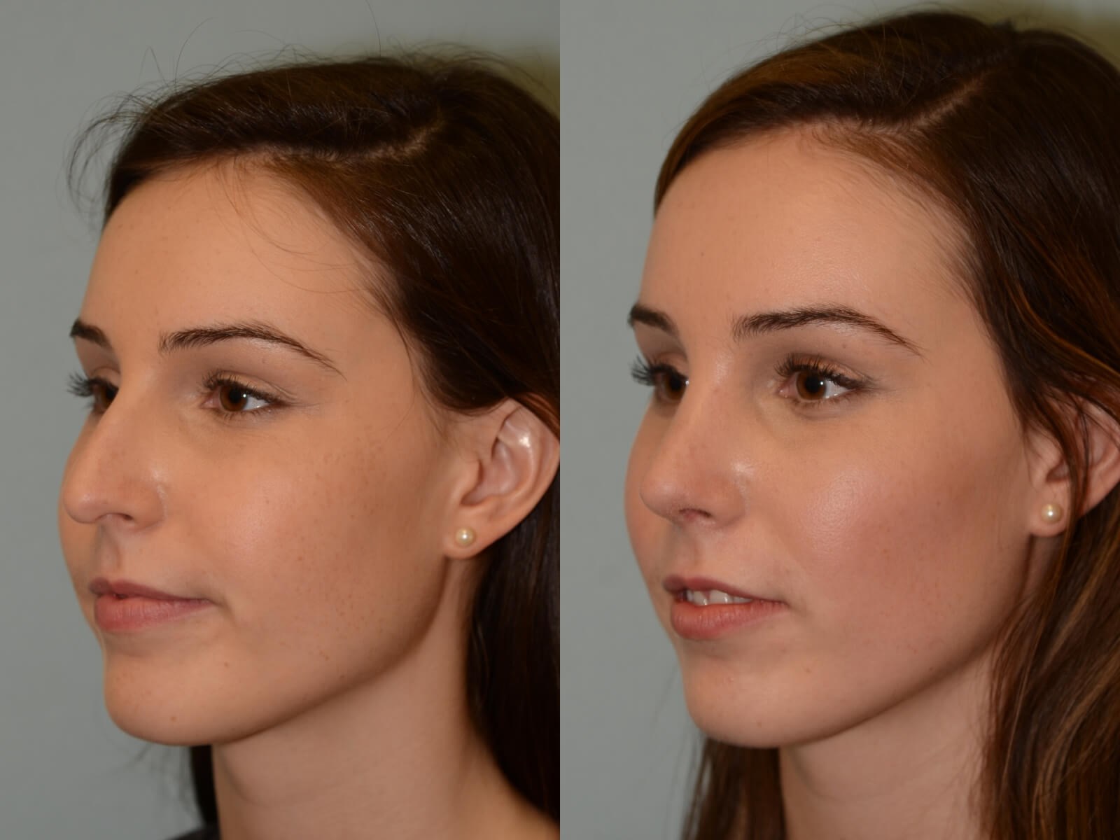 Rhinoplasty Before and After