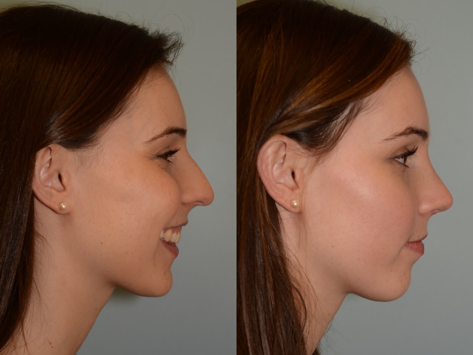 Rhinoplasty Before and After