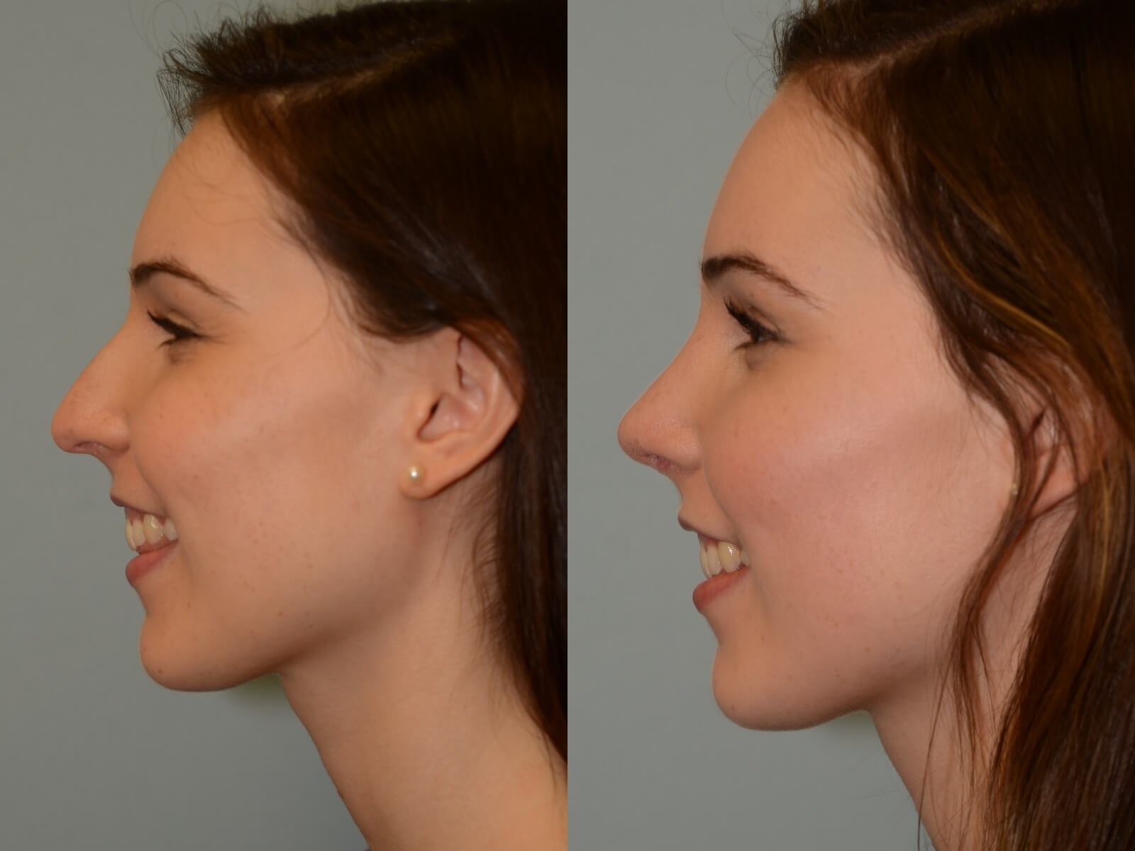 Rhinoplasty Before and After
