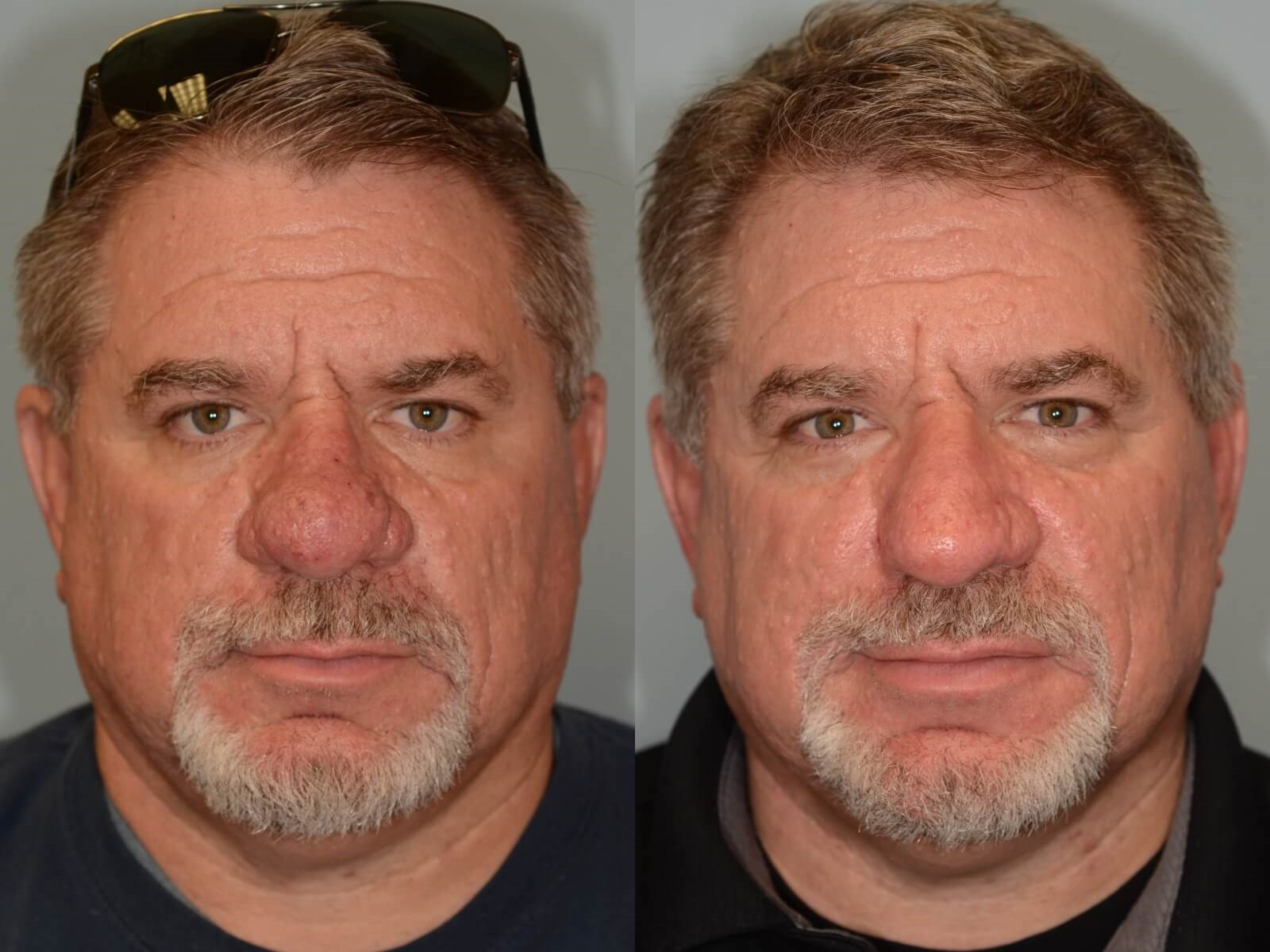 Removal of Rhinophyma Restores Nasal function! | Case 31820