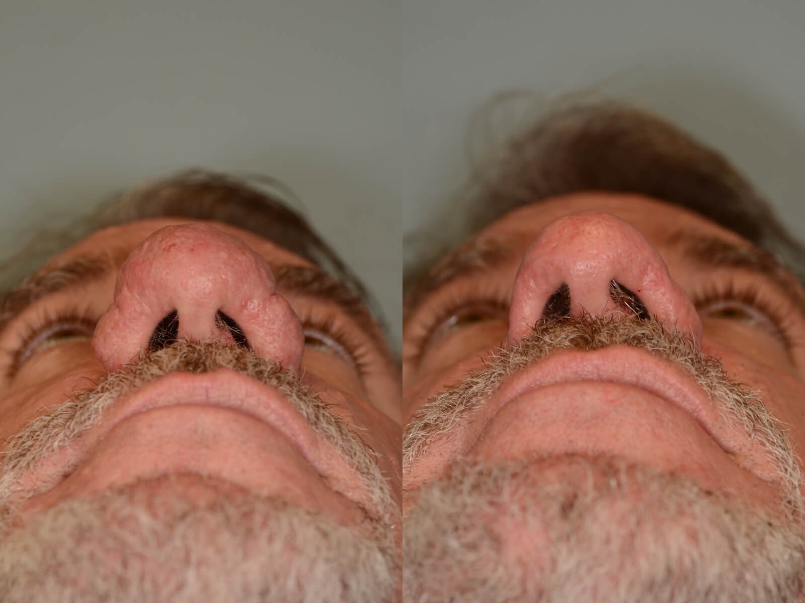 Removal of Rhinophyma Restores Nasal function! | Case 31820