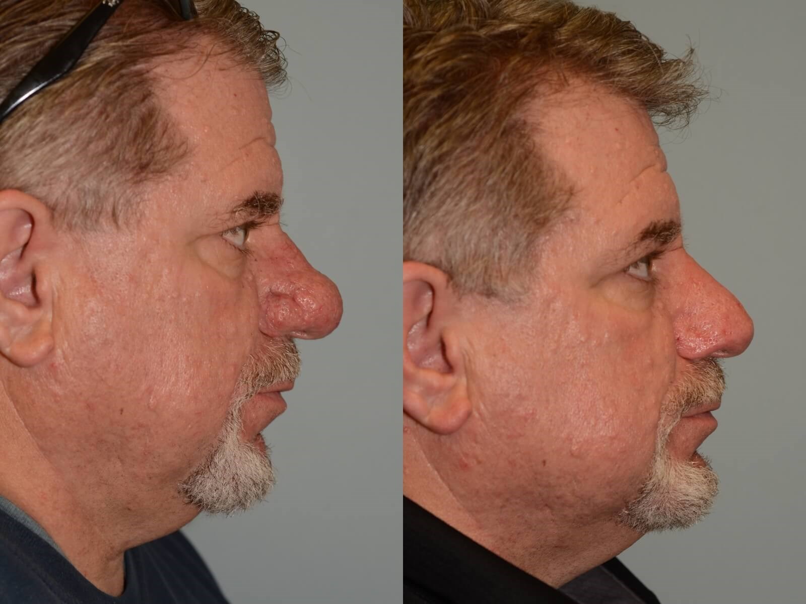 Removal of Rhinophyma Before and After