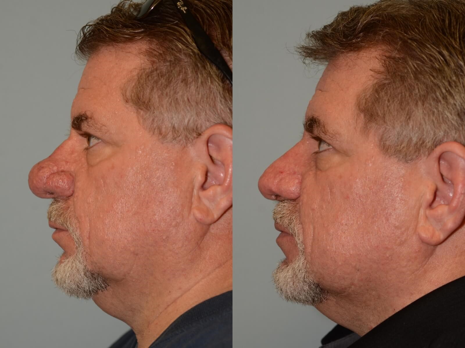 Removal of Rhinophyma Restores Nasal function!